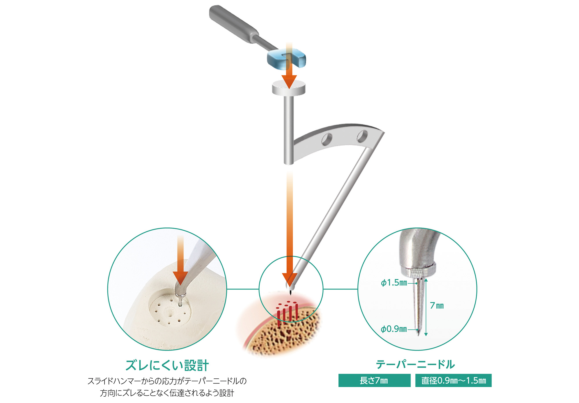 マイクロロータス🄬 | 製品情報 | 持田製薬 医療機器サイト